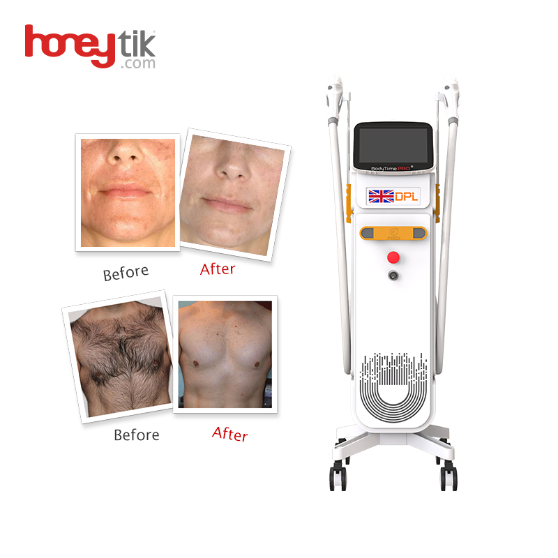 Dpl Laser Hair Removal Device Factory Price Oversized Smart Screen Remove Freckle Skin Whitening for Beauty Salon